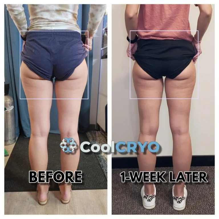 CoolCRYO: Butt & Outer hip saddlebag fat freezing