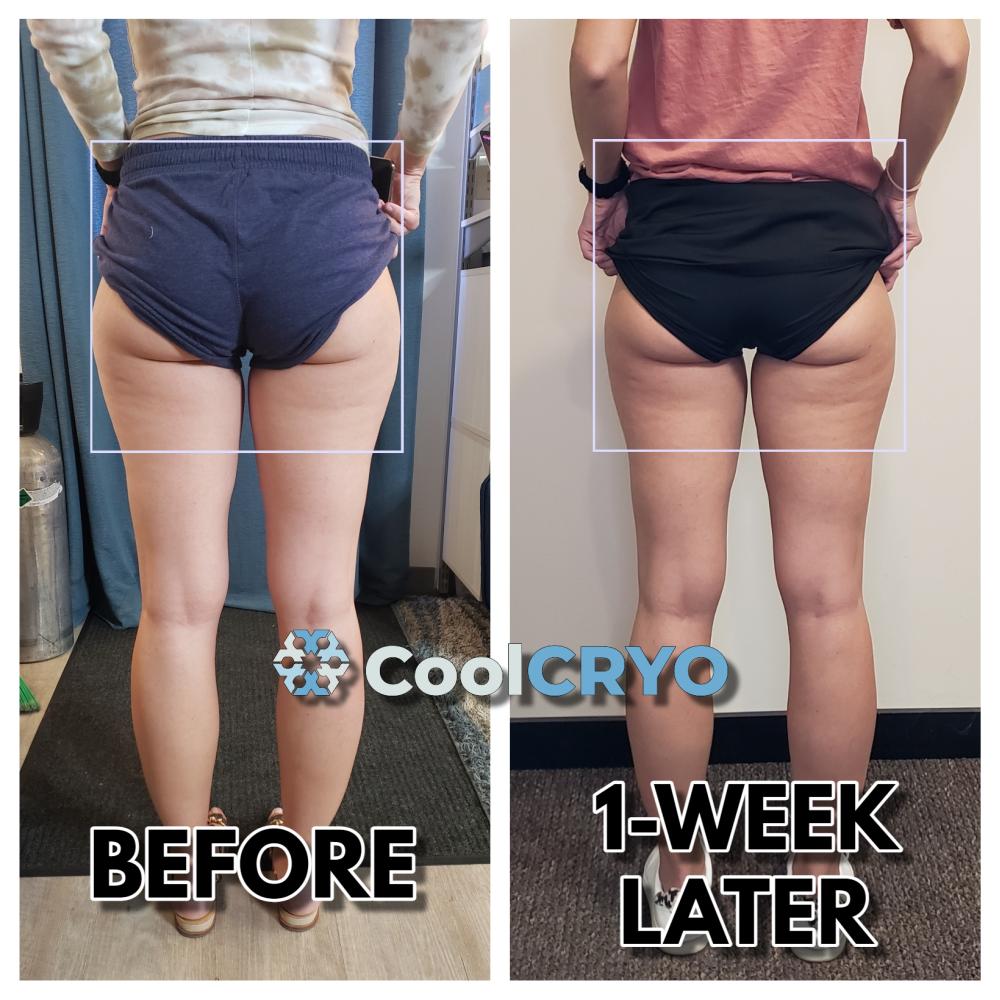 Coolcryo Reduce Fat Fix Cellulite And Tighten Skin Rapid City 2926