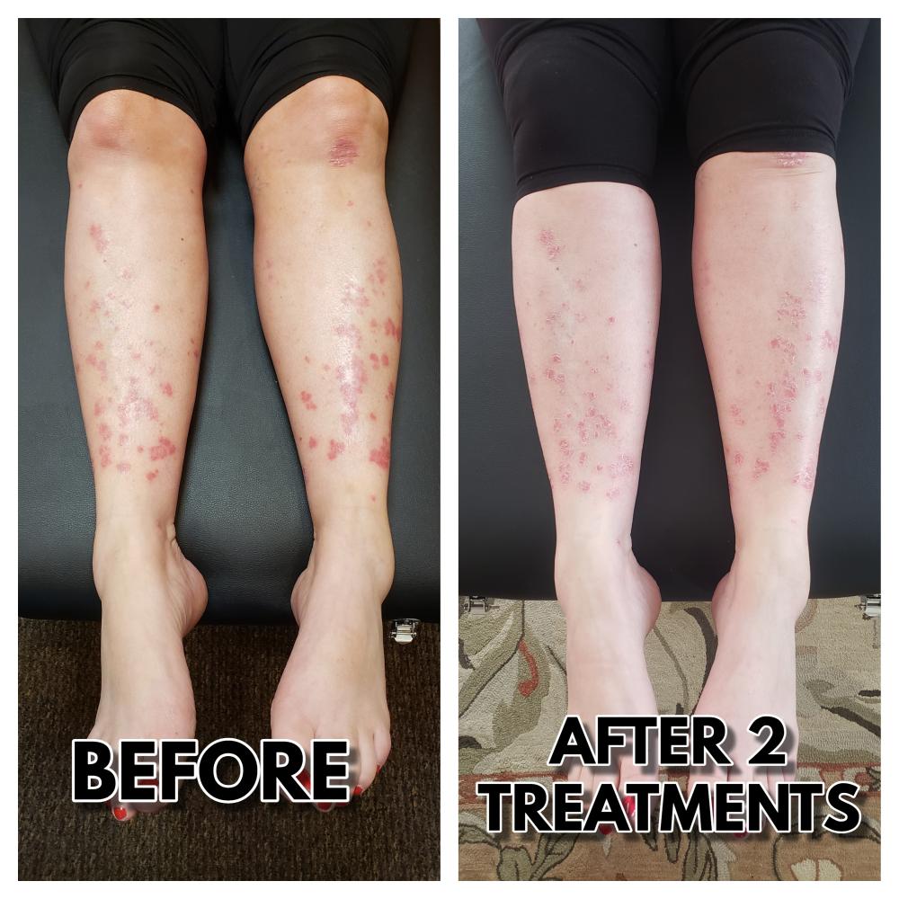 cryotherapy psoriasis treatment before & after