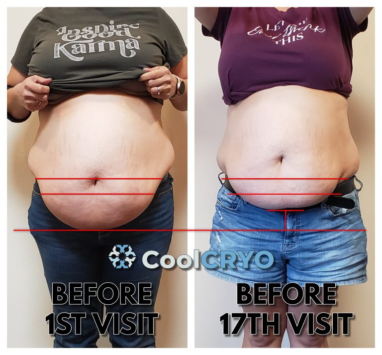 Belly Fat Freezing with CoolSculpting, CoolSculpting Stomach/Abdomen Before  and After photos