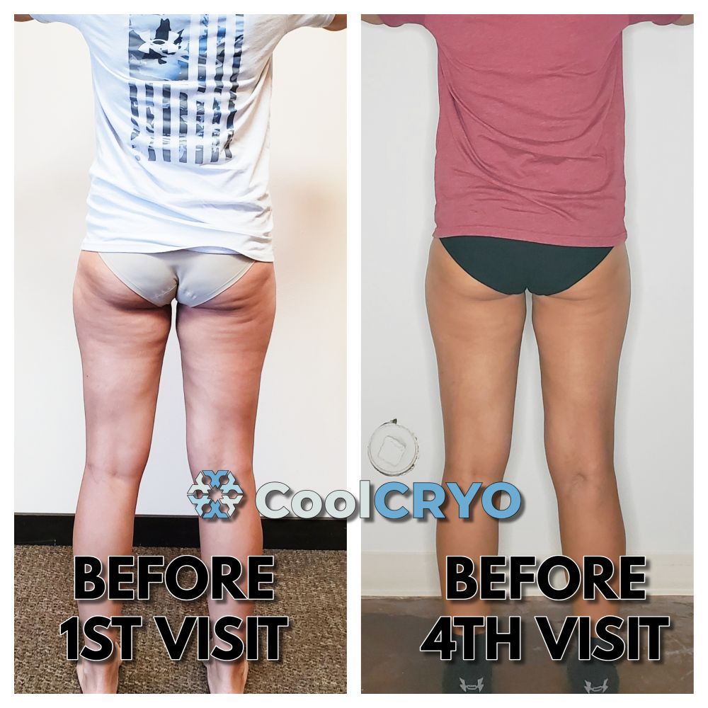 Compression Therapy Get Rid of Cellulite Rapid City, SD