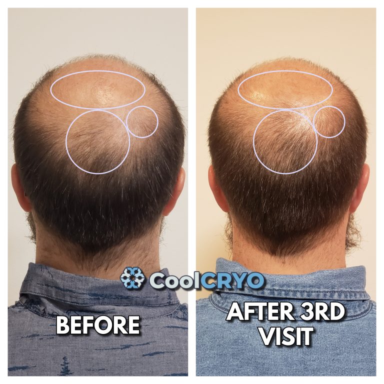 Cryo hair regrowth treatments in Rapid City