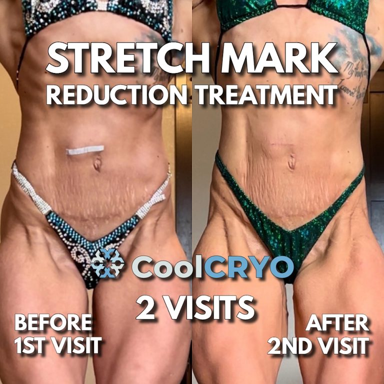 Stretch Marks - Kamloops Skin Solutions