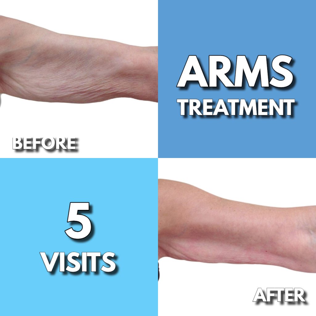 Before & After Photos | CoolCRYO