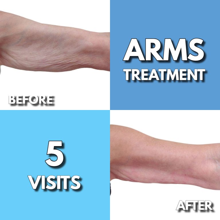 ThermaSlim - skin tightening on arms