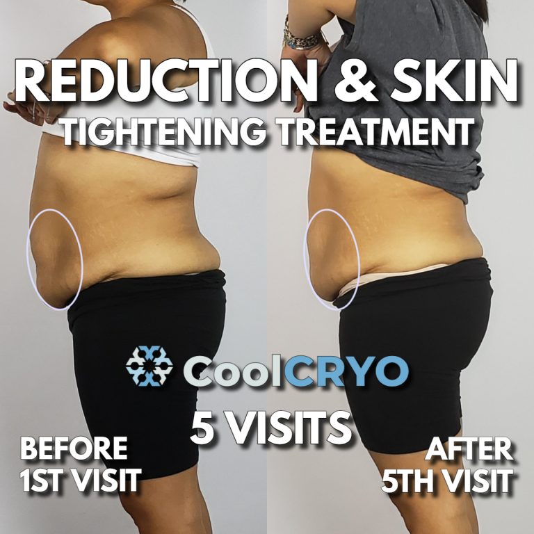 Are Cryo Body Sculpting Effects Permanent?