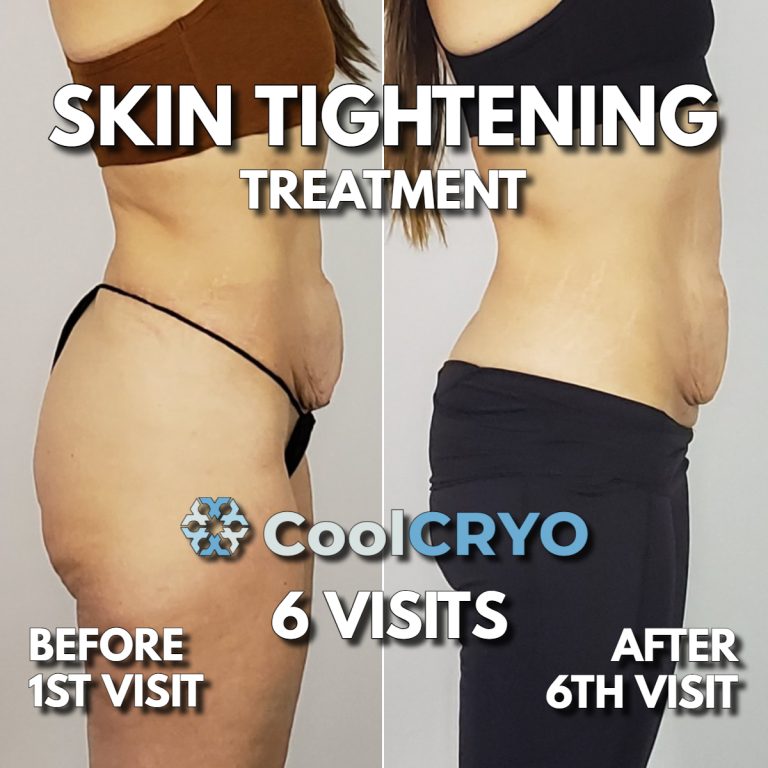 skin tightening on lower tummy - rapid city