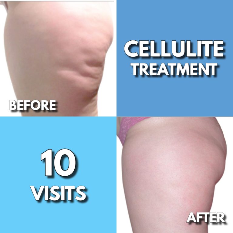 thermaslim cellulite treatment - before & after