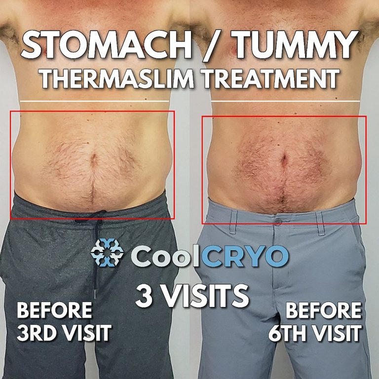thermaslim - fat reduction - stomach & love handles